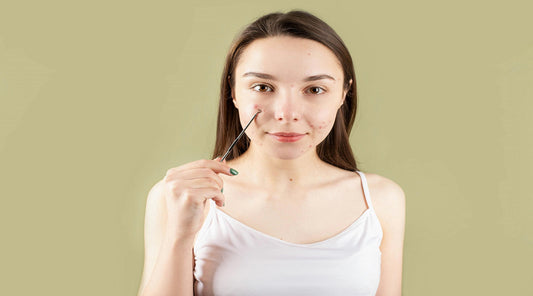 Can You Use a Face Oil for Hormonal Acne to Balance Breakouts